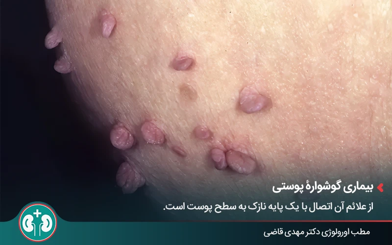 genital skin lesions 19