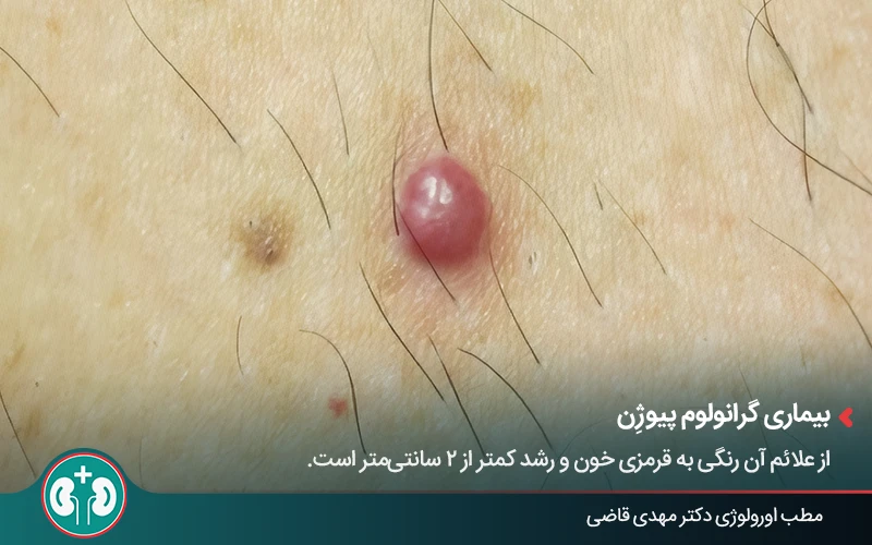genital skin lesions 20