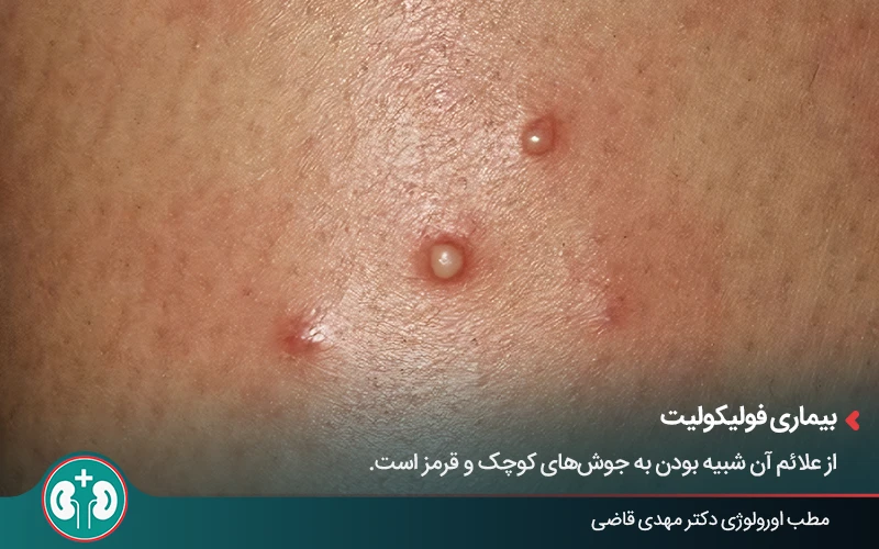 genital skin lesions 22