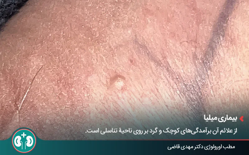 genital skin lesions 23