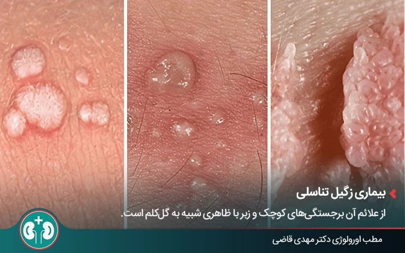 genital skin lesions 29