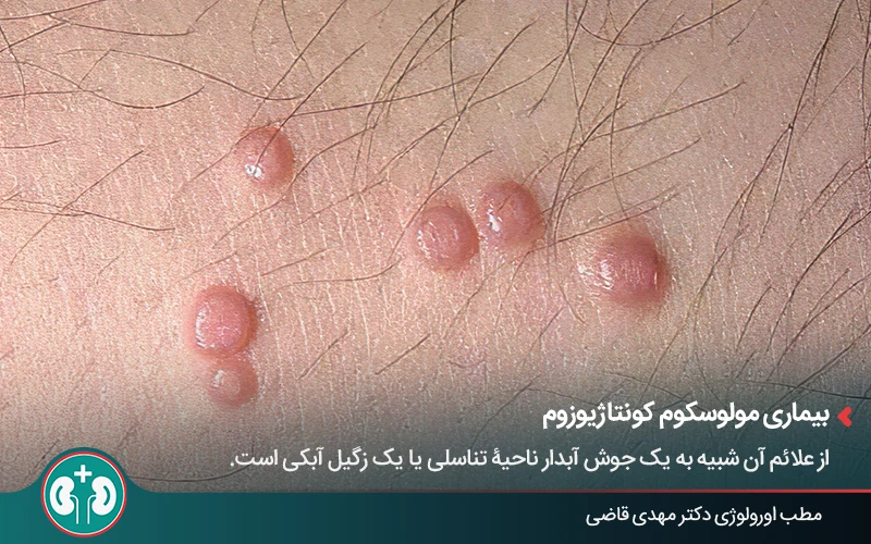 genital skin lesions 30