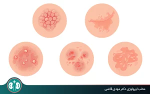 ضایعات و بیماری‌های پوستی دستگاه تناسلی مردان و زنان با عکس