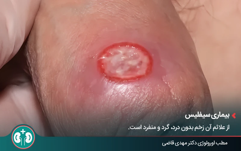 genital skin lesions 31