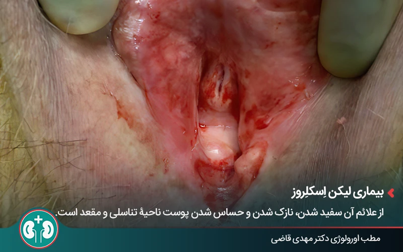 genital skin lesions 4