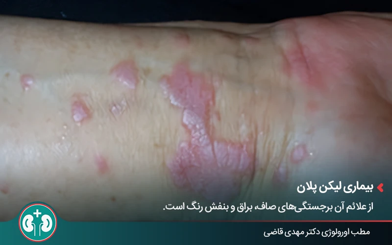 genital skin lesions 5