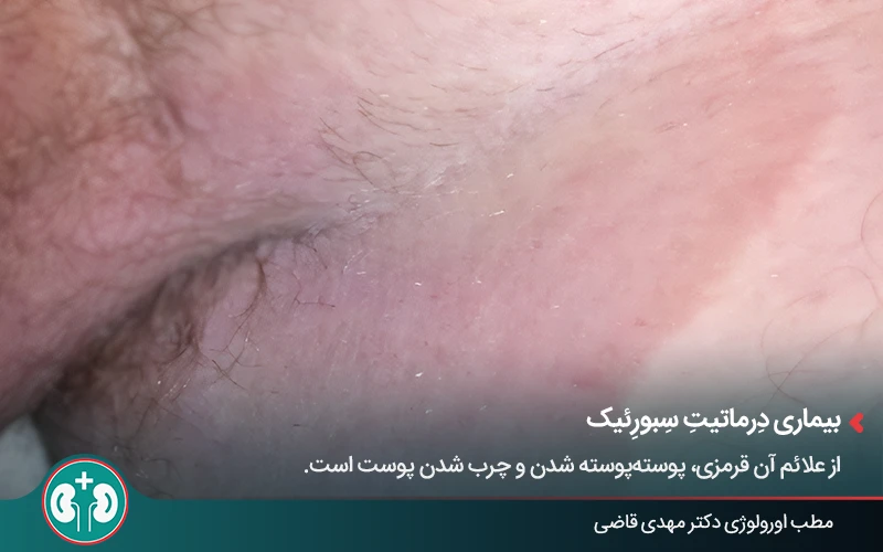 genital skin lesions 7