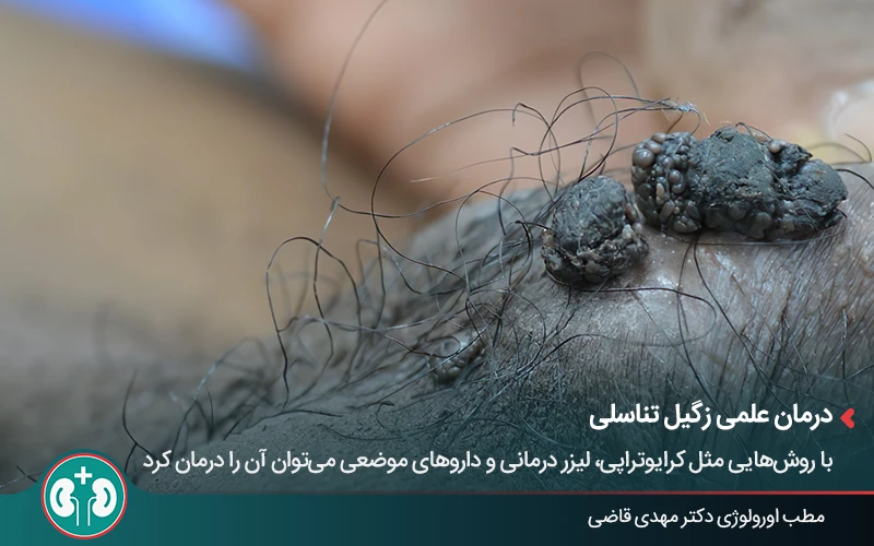 عکس از زگیل تناسلی تیره روی پوست ناحیه تناسلی