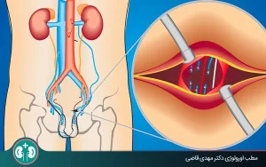 آیا درد بیضه بعد از عمل واریکوسل طبیعی است؟