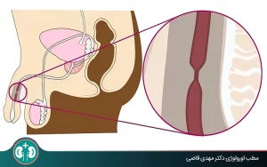 آیا تنگی مجرای ادرار در کودکان خطرناک است؟
