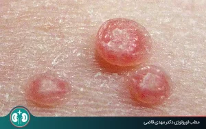 مولوسکوم بعد از چند مدت از بین می‌رود