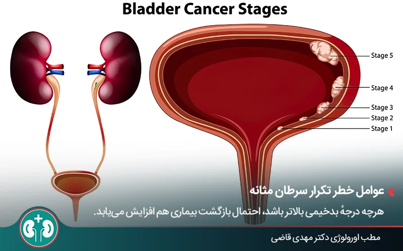 مراحل سرطان مثانه و اهمیت پیشگیری از بازگشت بیماری