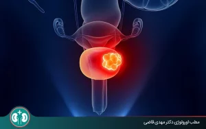 همه چیز درباره جلوگیری از عود سرطان مثانه؛ پیشگیری و مراقبت‌های پزشکی