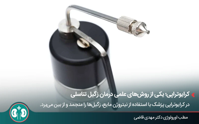 دستگاه کرایوتراپی، یکی از روشهای درمان زگیل تناسلی