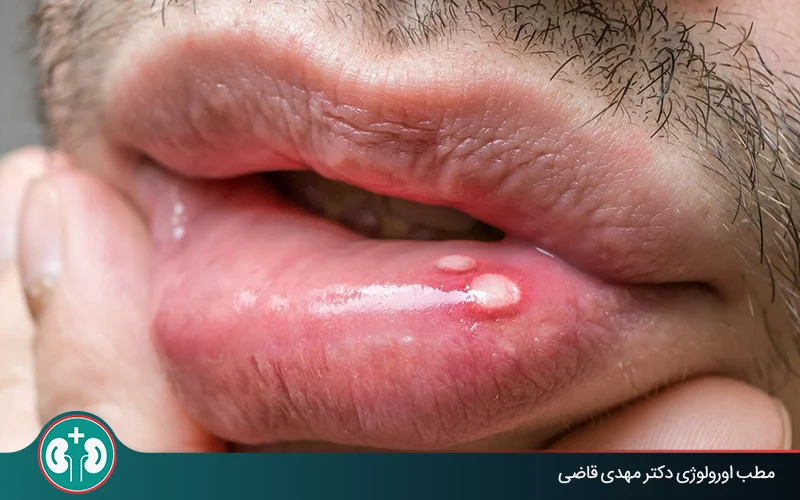 آیا تبخال دهان به ناحیۀ تناسلی منتقل می‌شود؟