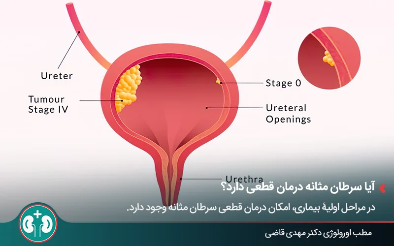 نمای شماتیک مثانه و توده سرطانی درون آن