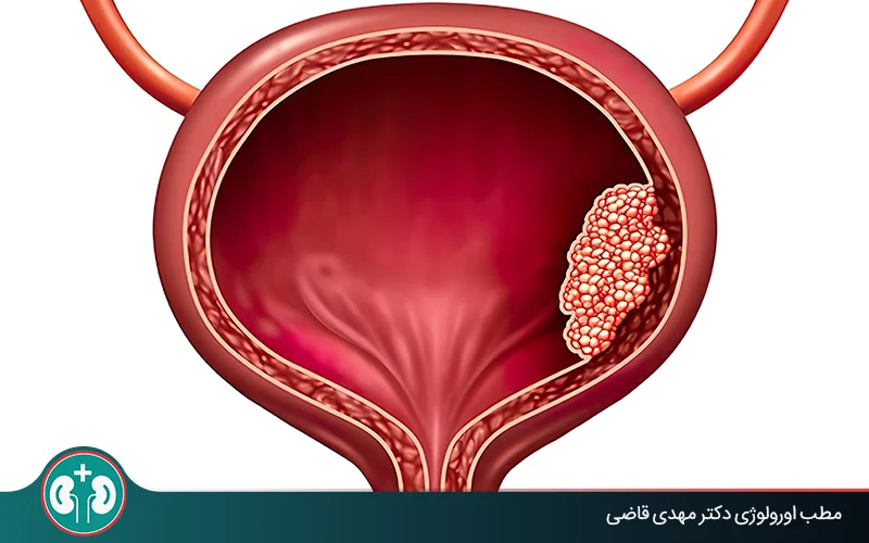 is bladder cancer curable