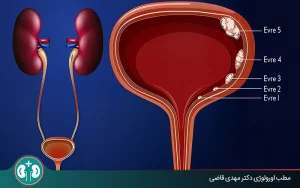 شناخت علائم سرطان مثانه بدخیم در مردان و زنان + زمان مراجعه به پزشک
