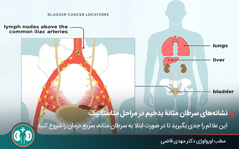 نقشۀ بدن انسان با نمایش مثانه، غدد لنفاوی درگیر سرطان و همچنین اعضایی مانند ریه، کبد و استخوان که سرطان مثانه میتواند به آنها متاستاز دهد.