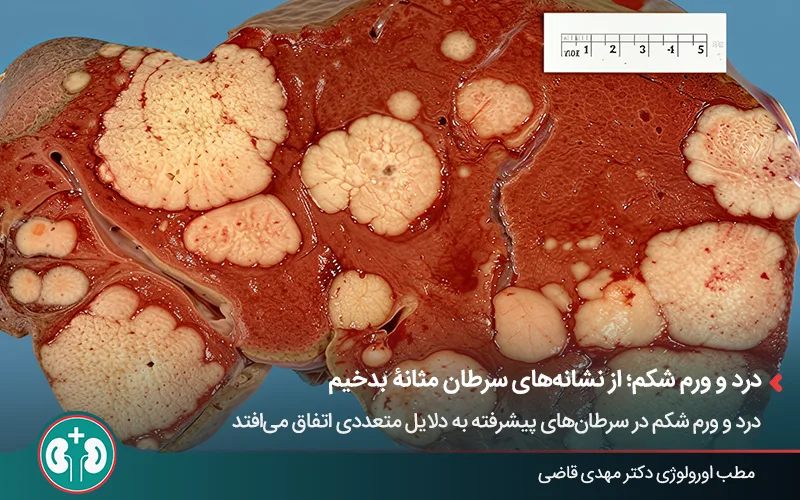 عکس واقعی یک کبد برش خورده با تودههای سرطانی متعدد.