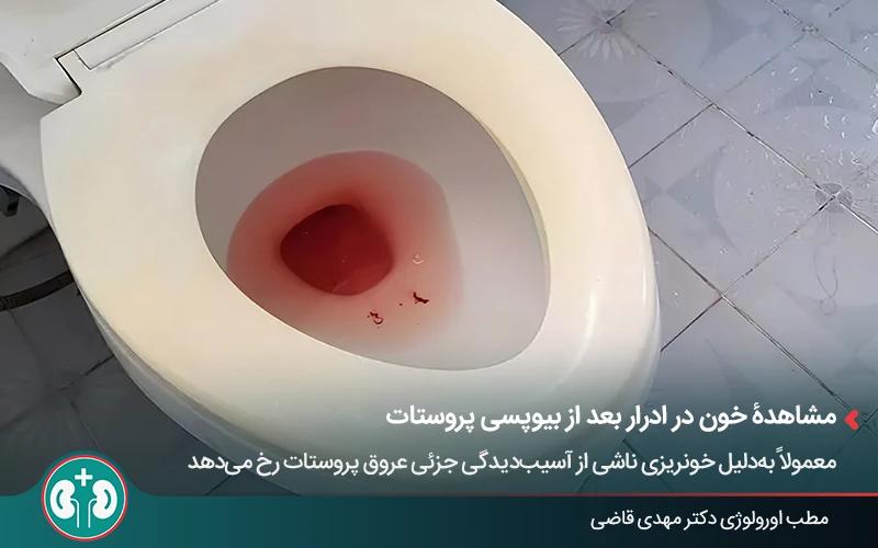 prostate biopsy side effects 3