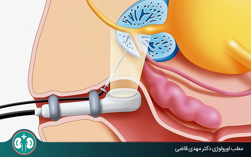 prostate biopsy side effects