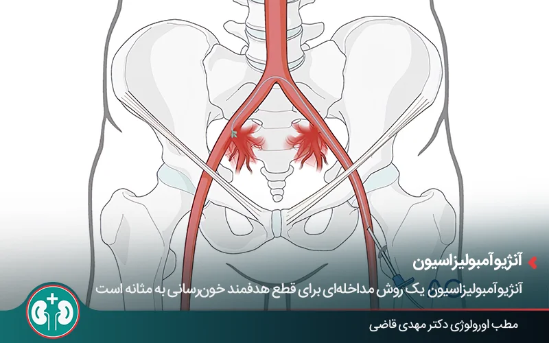 تصویر گرافیکی از کانتر درون شریان - آنژیوآمبولیزاسیون