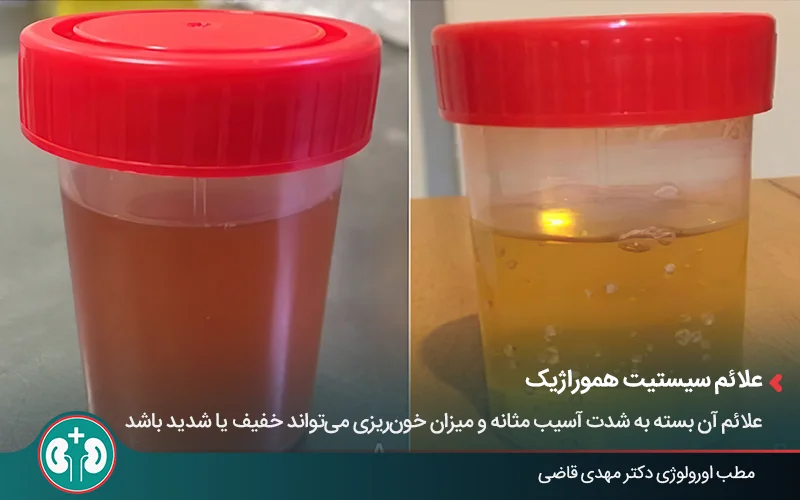 عکس دو نمونۀ ادرار یکی به رنگ زرد و دیگری قرمز و خونی (هماچوری ماکروسکوپیک)