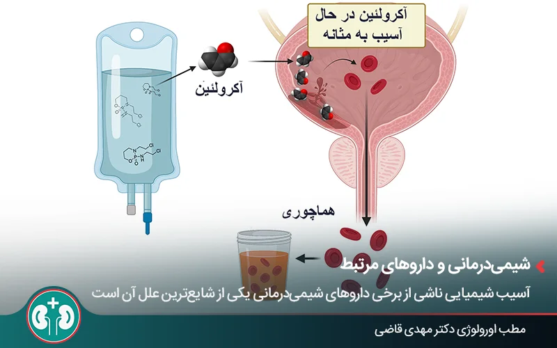 عکسی گرافیکی از داروی شیمی‌درمانی، مثانۀ آسیب‌دیده و ادرار خونی - توضیح تصویری نحوۀ عملکرد آکرولئین درون مثانه