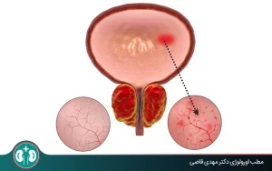 what is hemorrhagic cystitis