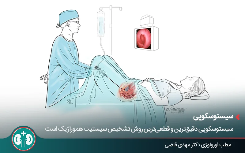 تصویر گرافیکی از پزشک و بیمار هنگام سیستوسکوپی