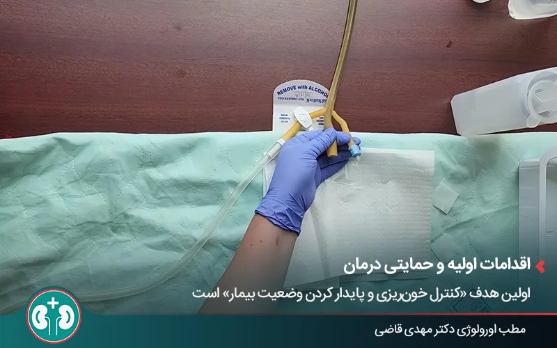 عکس سوند سه‌راه که برای شستشوی مثانه استفاده می‌شود