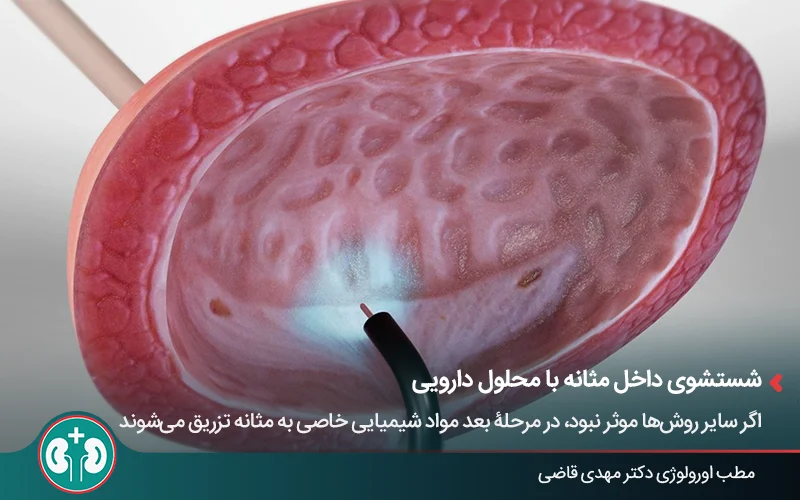 تصویر گرافیکی از تزریق دارو داخل مثانه