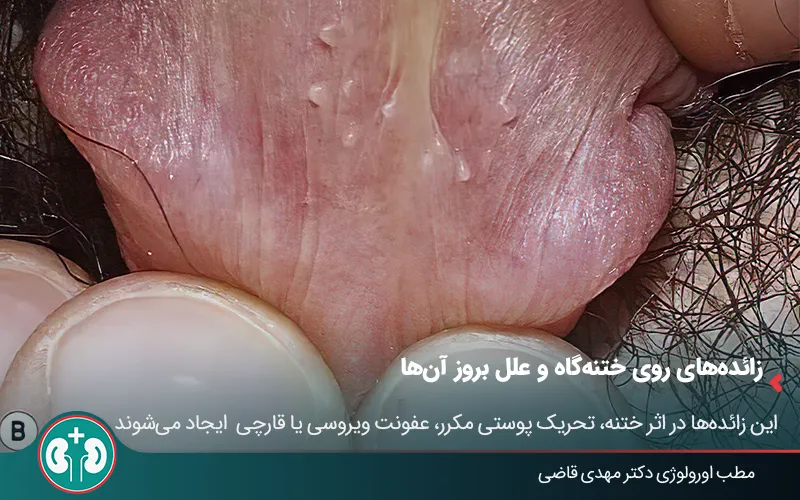 glans penis growths 1