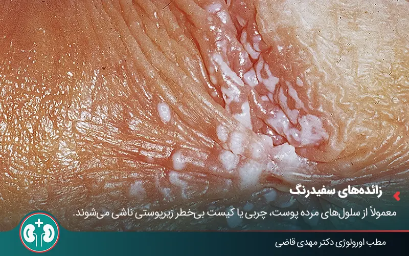 glans penis growths 2