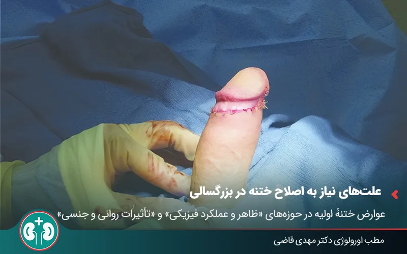 adult circumcision revision 02