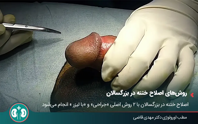 adult circumcision revision 03