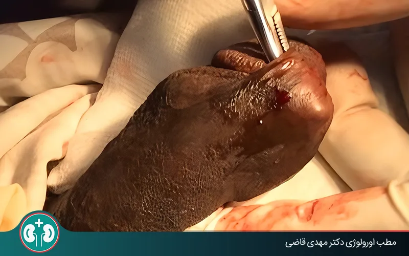 adult circumcision revision