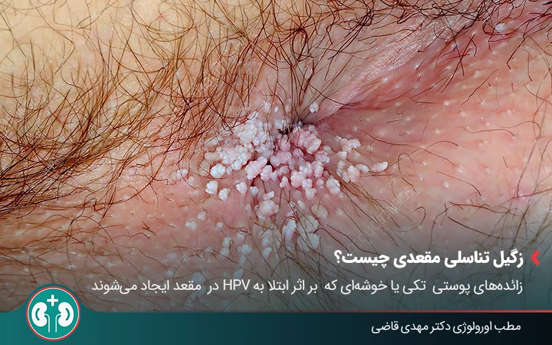 anal warts complications 01