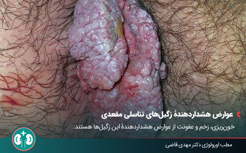 anal warts complications 02