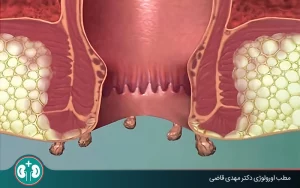 anal warts complications