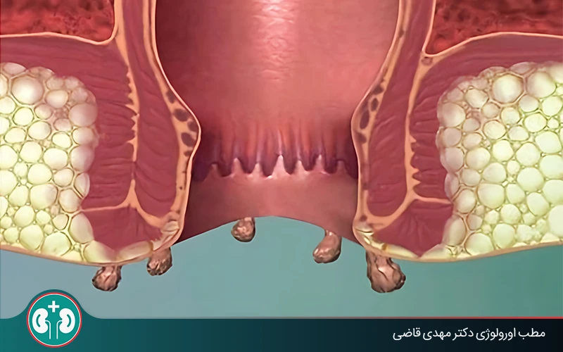 anal warts complications