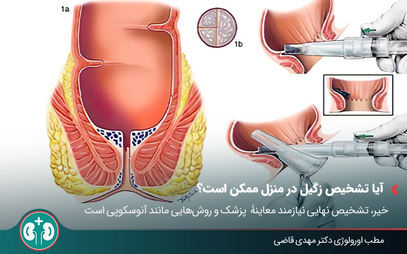 anal warts symptoms 02