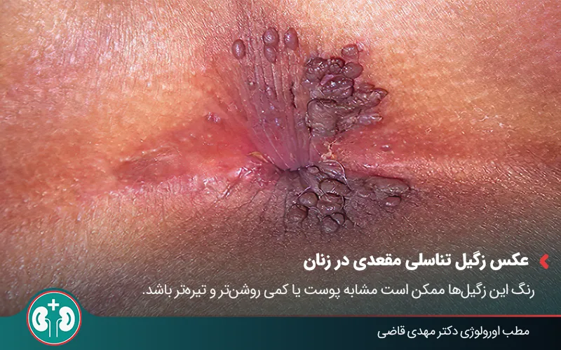 anal warts symptoms 03