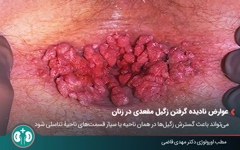 anal warts symptoms 04