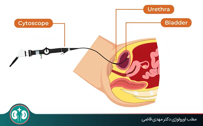 bladder cancer diagnosis ultrasound vs cystoscopy