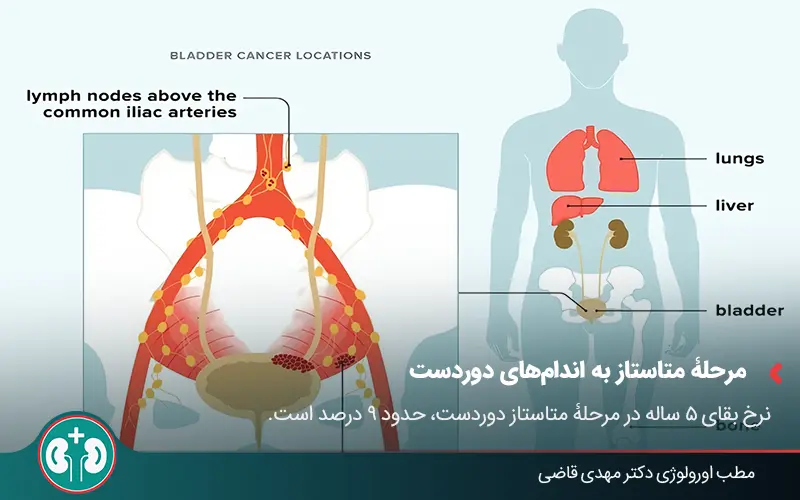 bladder cancer survival rate 02