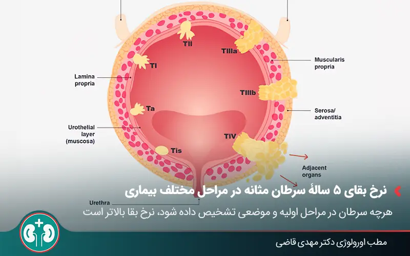 bladder cancer survival rate 1