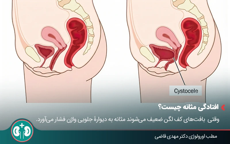 bladder prolapse laser therapy 01