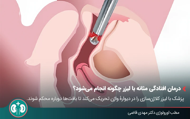 bladder prolapse laser therapy 02